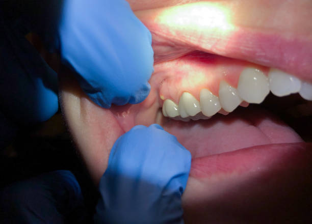 Best Emergency Wisdom Tooth Extraction in Lock Haven, PA